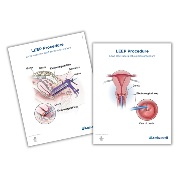 Sign/Handout_LEEP Procedure Patient Education Sign